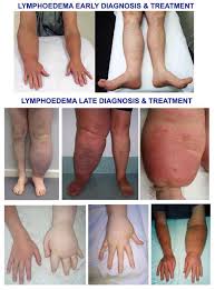 Different Stages Of Lymphoedema Lymphedema Lymphoedema Lymphedema Leg