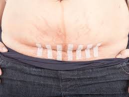 C Section Recovery Timeline Aftercare And Expectations Babycenter