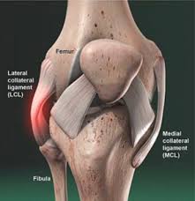 Medial collateral ligament (mcl) injuries are graded into three groups on mri, much in the same way as many other ligaments:. Lateral Collateral Ligament Injuries
