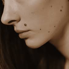 Yüz Bölgesinde Nevüs (Ben) Alma İşlemi￼