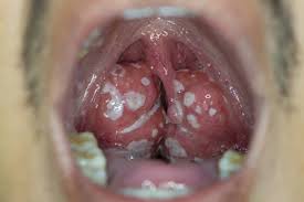 Image result for Tonsillitis