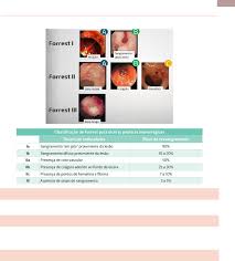 Classificação de forrest hemorragia digestiva alta forrest iia sinais de hemorragia recente. Hemorragia Digestiva Alta Gastroenterologia