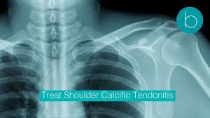 Image result for Rotator Cuff Calcification