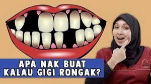 Gigi tiruan yang dibuat segera dibuat terlebih dahulu sebelum gigi asli dicabut dan dapat segera dipasangkan setelah gigi dicabut. Apa Nak Buat Kalau Gigi Rongak Youtube