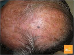 Looks like a pink spot that can be flat or raised. Skin Cancer On Scalp Skin Check Waskin Check Wa