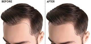 Con la sessione di trapianto di capelli con il metodo fue senza tagliare dei capelli il/la interessato /a ha la possibilità di ripristinare . Trapianto Di Capelli Senza Rasatura Esthetic Hair Turkey