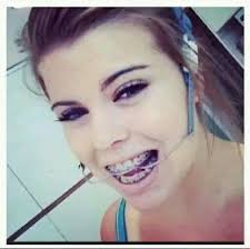 Experiences with Orthodontic Treatments and Braces