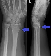 How long does it take for a broken wrist to stop hurting? Distal Radius Fracture Wikipedia