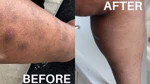To receive the best result, try using products you can find in drugstore (ointments, creams and patches), herbal therapies or surgeries. How To Minimise Scars On Legs Body Routine To Get Rid Of Body Scars Youtube