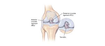 An access control lists acl is a function that watches incoming and outgoing traffic and compares it with a set of defined statements. Acl Injuries Temple Health