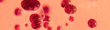 Image result for Microcytic Anemia