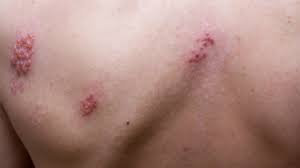 Fuoco di SantAntonio: come lavarsi? | Prof. Antonino di Pietro