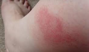 Sauter à la navigation sauter à la recherche. Piqures D Insectes Les Bons Reflexes Passionsante Be