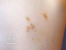 Image result for Urticaria pigmentosa children