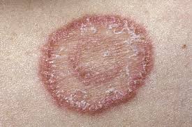 Common infections such as athlete's foot, jock itch, and ringworm are caused by fungus and are easy to get and to pass. Misdiagnosis Of Cutaneous Fungal Infections Leads To Missed Opportunities For Treatment