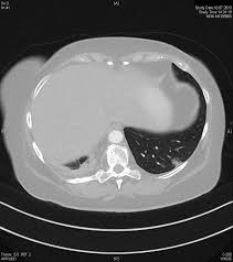 Most common benign tumor of lung, most often with chondromatous element typically solitary, 4 cm, composed of disordered but mature hyaline cartilage, fibrous tissue, smooth muscle, fat, sometimes with calcification / ossification shows some overlapping features with pulmonary chondroma of carney triad, but hamartomas tend to be single rather than multiple, favor men rather than women, and. Jenseits Von Gut Und Bose