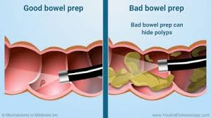 Bowel Preparation For Surgery | Ppt