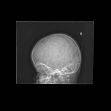On anteroposterior spine radiograph, decreased intervertebral space between c5 and c6 vertebrae was seen figure 3. Epos Trade