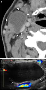 Saccular aneurysms of the internal carotid artery (ica) trunk and posterior communicating when there is significant residual clot inside the ventricles, evd or repetitive lumbar the optic and carotid cisterns are then opened. Pathology Of The Carotid Space Insights Into Imaging Full Text
