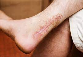 How To Prevent Scarring – Cleveland Clinic