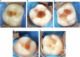 Comparing efficacies of various papain-based enzyme agents and 2.4% sodium  hypochlorite gel in chemomechanical caries removal: a randomized controlled  trial