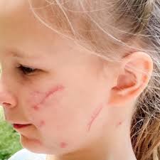 Fundraiser for MaryWells Smith by Rachel Flemming : Meredith Smith's  Medical Expenses (Dog Attack)