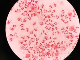 In diesem weit fortgeschrittenen stadium der syphilis hat sich der erreger bereits auf den gesamten körper ausgebreitet. Syphilis Symptome Erkennen Bilder Behandlung Prognose