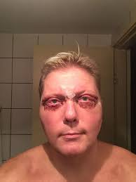 Vesa Keskinen toipuu kauneusleikkauksestaan