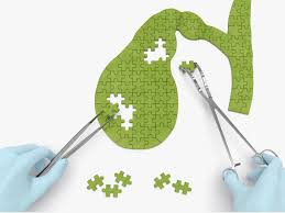 Gallbladder Attack Symptoms Treatment Outlook And More