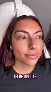 💋 Pucker up, babe — your dream lips are only one appointment away!, With  REVANESSE® Lip Filler, you get smooth, natural-looking volume that keeps  everyone guessing 👀✨, 📅 Book today and let your lips ...