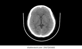 Image result for CT Head