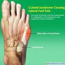 5. dorsal compression syndrome  achy pain with activity that is more toward the top of the foot, rather than the side. Pin On Joint Pain Relief