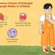 Cancerous lymph nodes may feel rubbery and clumped together in the case of lymphomas or hard and immobile in the case of metastatic cancers, according to the merck manual home edition. Swollen Glands And Lymphadenopathy In Children