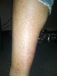 Occasionally, red bumps on your legs are the sign of a more serious condi. Red Spots On My Legs Appeared Today Any Idea What It Is Imgur