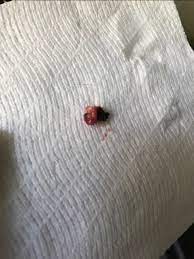 You can be having a miscarriage and not have the pain but eventually your cervix may dialate and you will feel cramping and bleeding. Does This Look Like A Miscarriage Glow Community