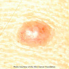 Use these first five letters of the alphabet as a Normal Mole Vs Melanoma What To Look For In A Self Exam