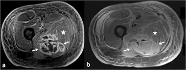 The muscles and fasciæ of the thigh. Mri Of Myositis And Other Urgent Muscle Related Disorders Springerlink