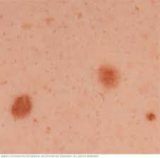 This is the most common type of skin cancer. Melanoma Symptoms And Causes Mayo Clinic