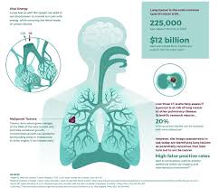 Medically reviewed by seunggu han, m.d. Nearly 10 000 Global Problem Solvers Yield Winning Formulas To Improve Detection Of Lung Cancer In Third Annual Data Science Bowl Business Wire