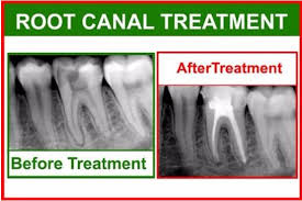 However, to avoid needing root canal treatment, anyone who has a toothache should see a dentist promptly to prevent any infection from getting worse, forming an abscess, or spreading throughout the tooth root system. Root Canal Therapy Family Dentistry In Canton Oh Drs Craig Henzel And Steven Smith Dds