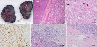 Usually associated with better prognosis than follicular thyroid cancers, but some tumor subtypes are more aggressive than others. A Synchronous Papillary And Follicular Thyroid Carcinoma Presenting As A Large Toxic Nodule In A Female Adolescent International Journal Of Pediatric Endocrinology Full Text