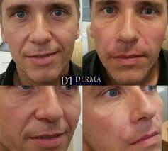 What is the best filler for nasal folds? Nasolabial Line Filler Derma Models