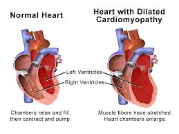 Image result for Cardiomyopathy