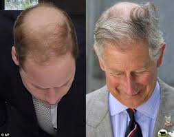 Surgeon Reveals What William And Harry Will Look Like When They Re 50 Hair Loss Baldness Cure Help Hair Loss