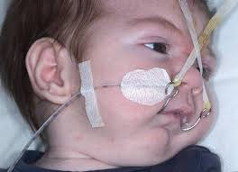 It is commonly known as treacher collins syndrome (tcs). Die Fruhbehandlung Der Pierre Robin Sequenz Einer Speziellen Form Der Gaumenspalte Springerlink