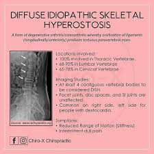 Dish One Of The Uncommon Spinal Conditions But Easily Detected Through A Lateral Film And An Ap Film Can Candle Wax Dripping Thoracic Vertebrae Chiropractic