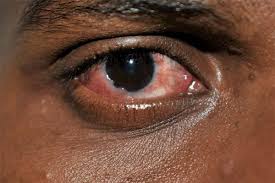 Image result for Conjunctivitis
