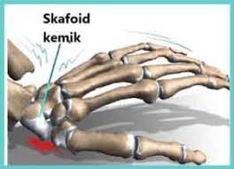 Skafoid Kemigi Kirigi Fizyoterapi Kemik Elsa
