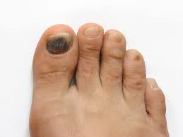 Image result for diabetic toes