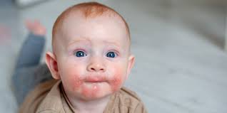 Allergies to animal hair, pollen or dust mites. Neurodermitis Bei Babys Erkennen Allcon